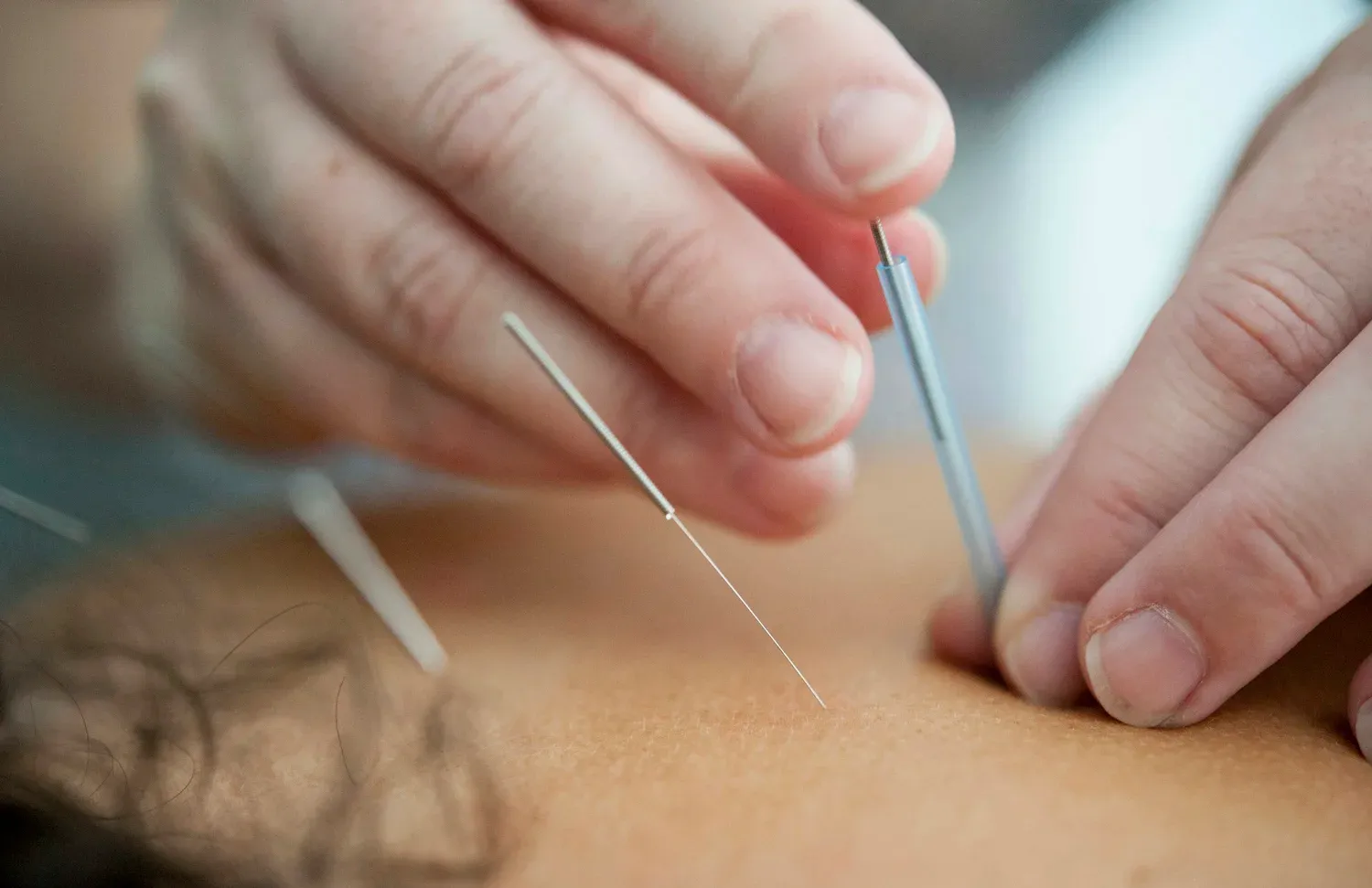 Close-up of hands placing a thin acupuncture needle